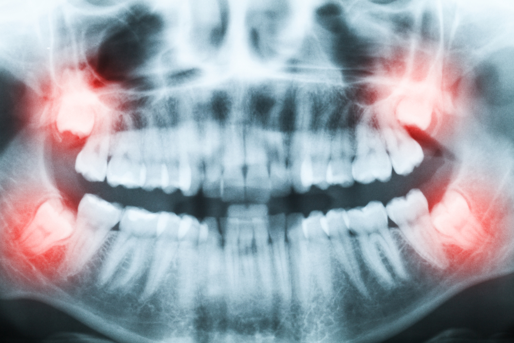 Impacted wisdom teeth on an x-ray